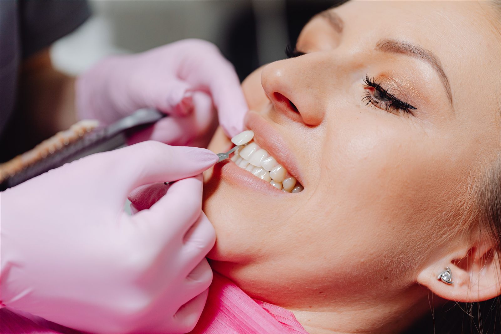 Aplicare fațete dentare — estetică dentară EBIDENT