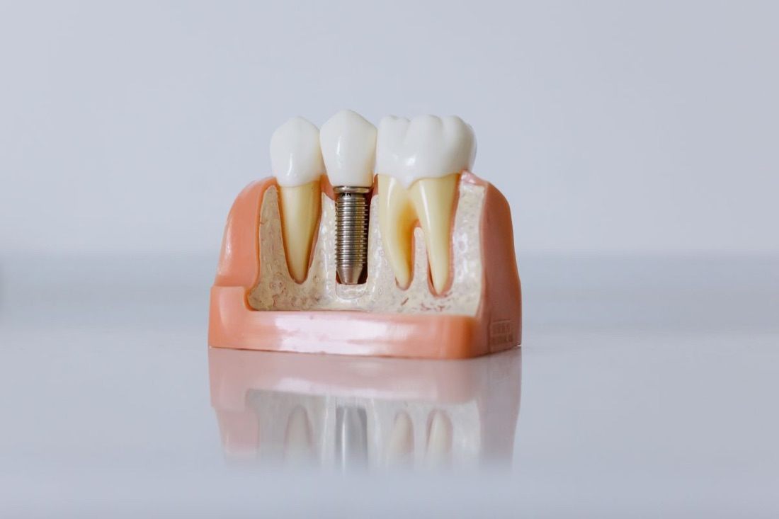 Igiena după un implant dentar